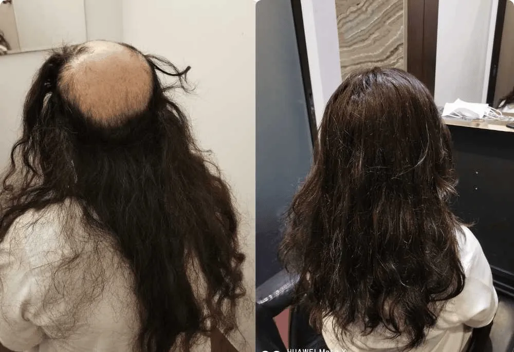 Hair Replacement SG's cover photo